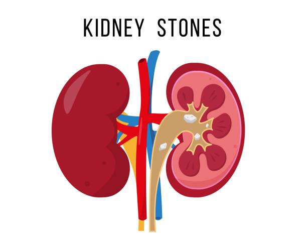 Kidney Stone Treatment