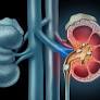 about-kidney-stone